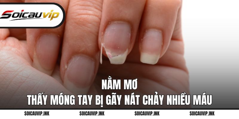 Nằm mơ thấy móng tay bị gãy nát chảy nhiều máu